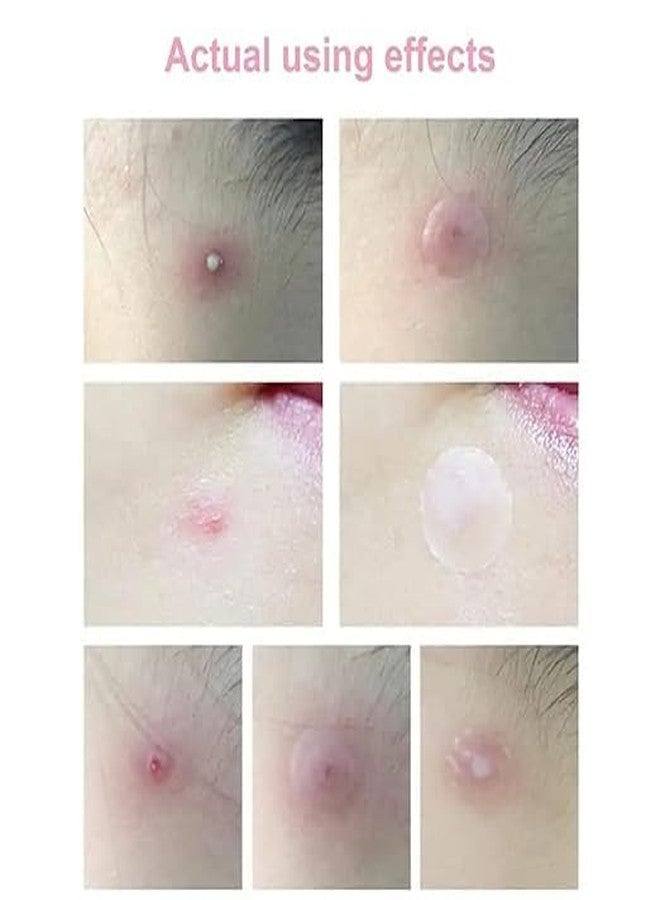 FLIZZOW Pimple Patch, Hydrocolloid Acne Dots, 36 Patches, Skin Tag Cover for Face, All Skin Types - Image 3