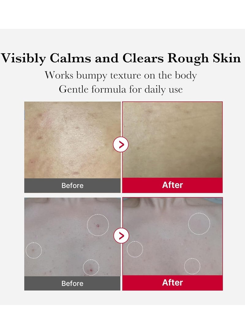 ميديكيوب جرعة تقشير الجسم من ميديكيوب ريد لعلاج حب الشباب، منظف بخاخ للجسم بنكهة الفراولة، حمض ألفا هيدروكسي + حمض بيتا هيدروكسي + حمض السكسينيك، مقشر، 3.88 أونصة. - Image 5