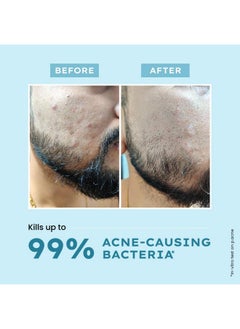 HYPHEN Acne Defence Daily Serum For Acne Prone Skin With Salicylic Acid 2% Azelaic Acid 10% Niacinamide 4% Treats Active Acne Controls Oil Antiacne Serum For Men & Women 30 Ml  - Image 3