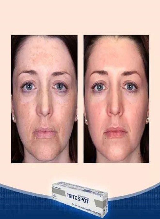 EVAPHARMA Tritospot Topical Cream For Hyperpigmentation Problems Men and Women 15g - Image 4