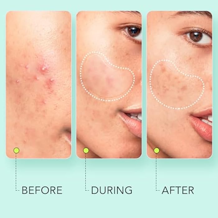 LitBear Large Pimple Patches (7 Sizes 306 Patches), Big Acne Patches, XL Hydrocolloid Bandages for Full Face, Forehead, Chin, Nose, Body, Back, Neck & Chest, Oval, Moon, Square hydrocolloid Patch - Image 5