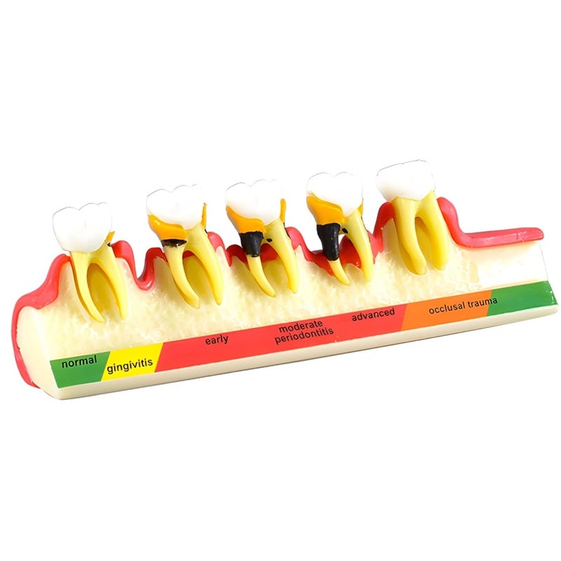 Individual & group usable Tooth Model Showing Periodontal Disease Stages, Resin, 6.1 in Upgraded simple practical design - Image 1