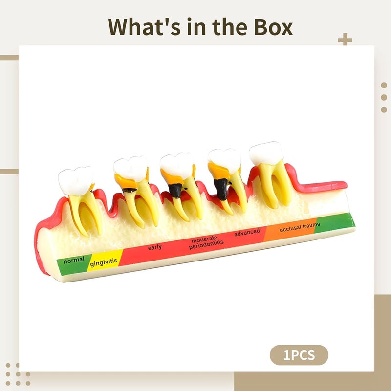 Individual & group usable Tooth Model Showing Periodontal Disease Stages, Resin, 6.1 in Upgraded simple practical design - Image 3