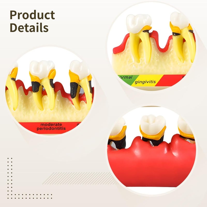 Individual & group usable Tooth Model Showing Periodontal Disease Stages, Resin, 6.1 in Upgraded simple practical design - Image 5