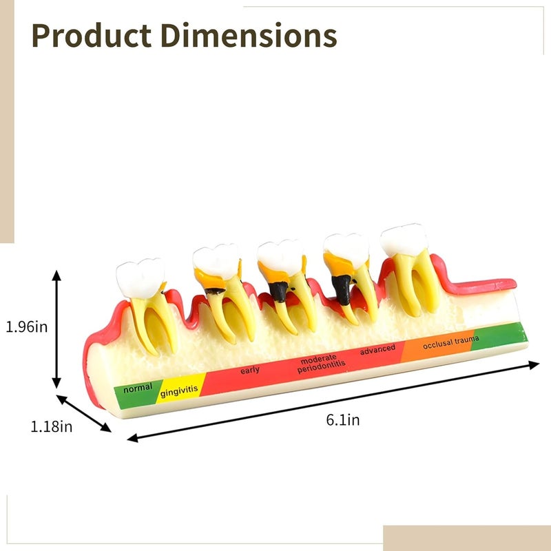 Individual & group usable Tooth Model Showing Periodontal Disease Stages, Resin, 6.1 in Upgraded simple practical design - Image 2