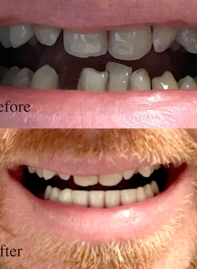 Instant Smile Professional Cosmetic Lower Teeth - New from ! Hand crafted detail, custom fit at home! - Image 2