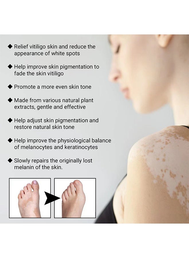 SOL LORA Vitiligo Removal Relief Spray，Promote Melanin Recovery,Reduces White Spots on Skin and Improve Skin Pigmentation,Vitiligo Care Spray（30ml） - Image 3