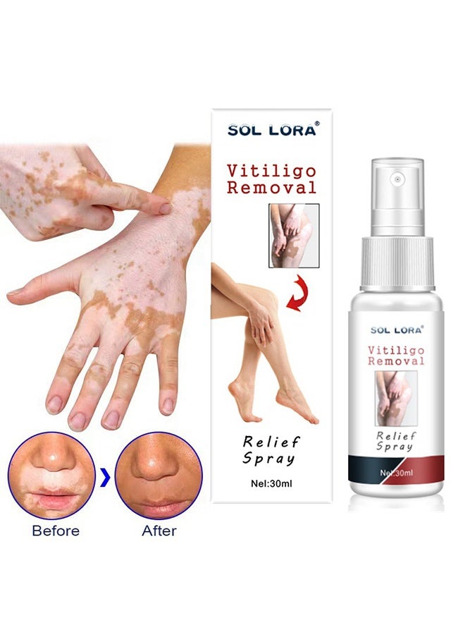 SOL LORA Vitiligo Removal Relief Spray，Promote Melanin Recovery,Reduces White Spots on Skin and Improve Skin Pigmentation,Vitiligo Care Spray（30ml） - Image 2