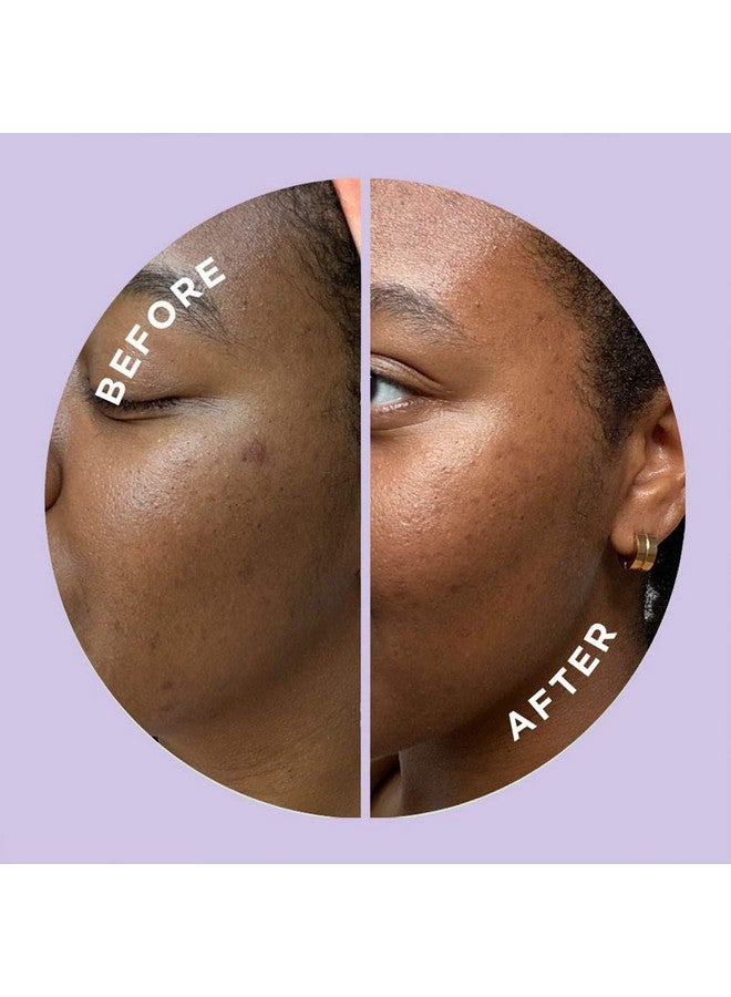 ZitSticka Hyperfade Acne Patches for Face - World's Most Potent Pimple Patch with Fast-Acting Microdarts - Starts Working within 2 Hours for Deep, Early-Stage Zits & Blemish - 4 Count - Image 4