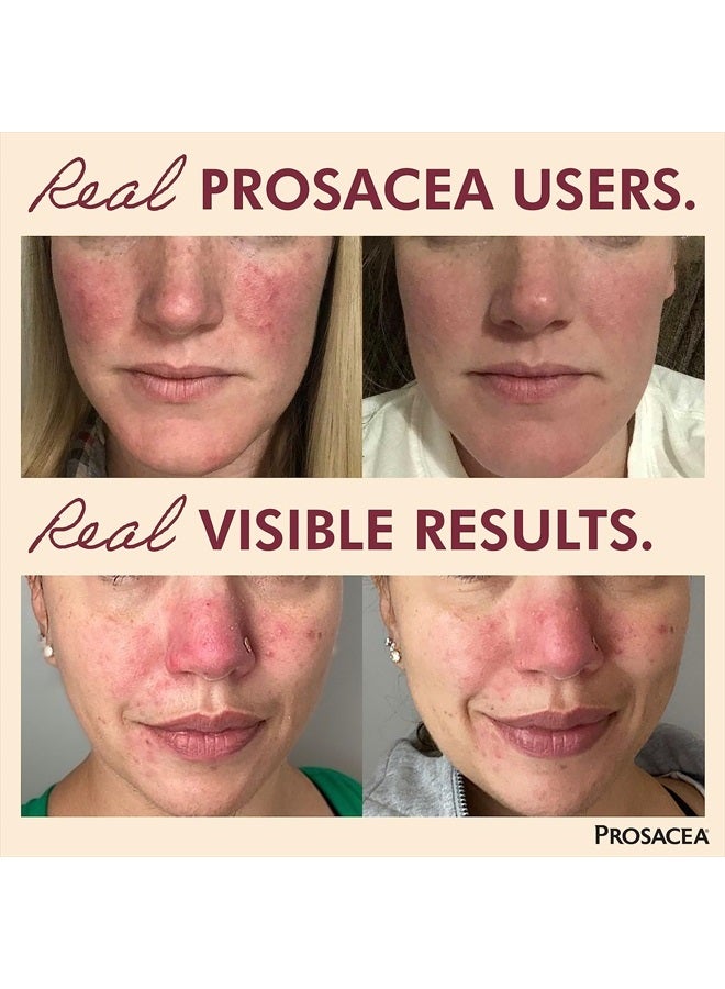 Prosacea Controls Maskne Rosacea Symptoms of Redness, Pimples & Irritation, 0.75 Oz - Image 2