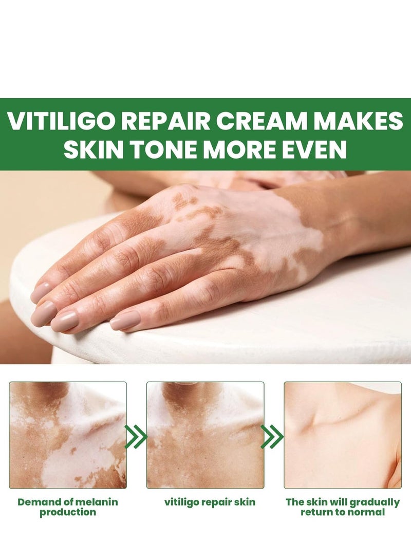 EELHOE Vitiligo Repair and Revitalizing Cream, Vitiligo Treatment Soothing Cream, Vitiligo Treatment Cream, Effectively Improve Skin Pigmentation and Lighten Vitiligo, Reduce White Spots 15g - Image 2
