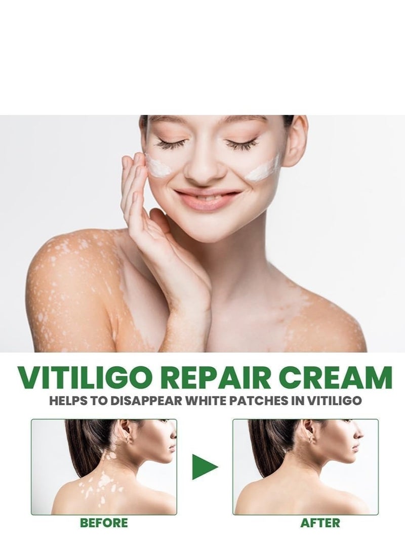 EELHOE Vitiligo Repair and Revitalizing Cream, Vitiligo Treatment Soothing Cream, Vitiligo Treatment Cream, Effectively Improve Skin Pigmentation and Lighten Vitiligo, Reduce White Spots 15g - Image 3