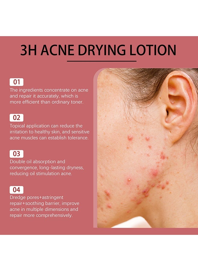 Zyvarn 3H Acne Drying Lotion, Drying Lotion Face Serum, Hydrating Facial Essence for Oil Control, Clean Pore & Smooth Skin, For All Skin Types,30ml 1 Fl Oz (1Pcs) - Image 5