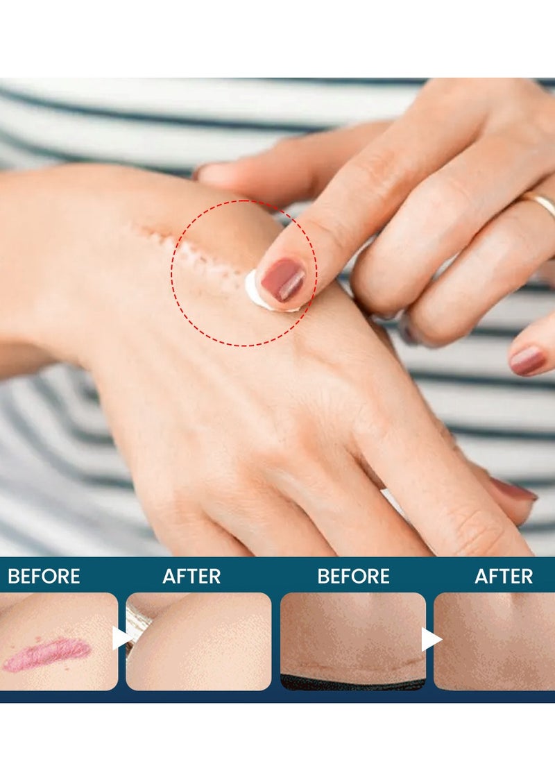 سوميفون كريم إصلاح الندبات، كريم إصلاح، جل إصلاح تضخم الجلد بدون ندبات، جل الندبات، علاج ندبات حب الشباب، حرق الندبات، إصلاح الدهون، الجلد التالف، إزالة علامات حب الشباب، كريم إصلاح الندبات. - Image 5