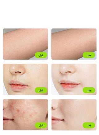 T14 Laser Hair Removal For Women And Men, Replaceable Permanent Laser Hair Removal 500000 Flashes For Facial Legs Arms Whole Body Treatment Dark Blue - view 2