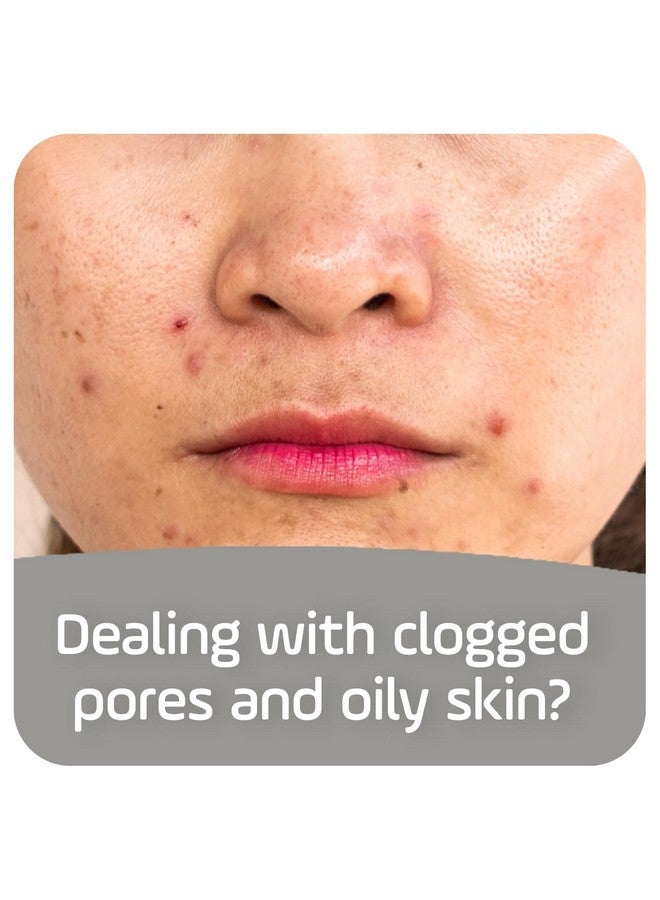 أسيبسيا صابون أسيبكسيا لعلاج حب الشباب وتنظيفه بعمق، مع صودا الخبز وحمض الساليسيليك بنسبة 2%، 4 أونصة - Image 2