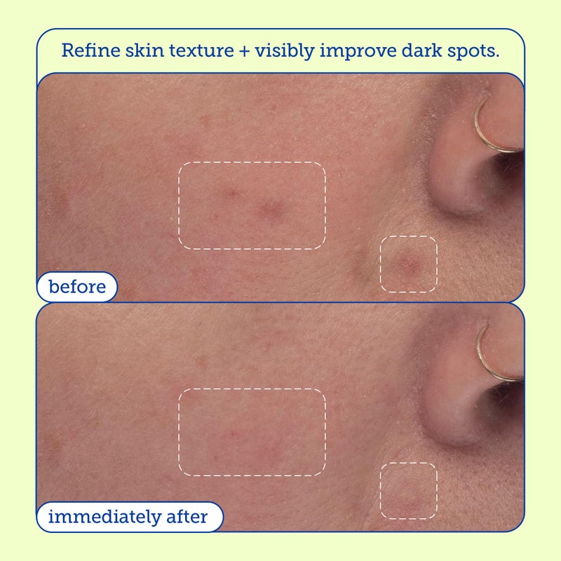 Skinfix AHA/BHA Niacinamide Exfoliating Pads - 60 Pads - Visibly Reduces Discoloration, Removes Dead Skin, Releases Ingrown Hairs & Unclogs Pores with Lactic Acid - Vegan, Cruelty Free - Image 4