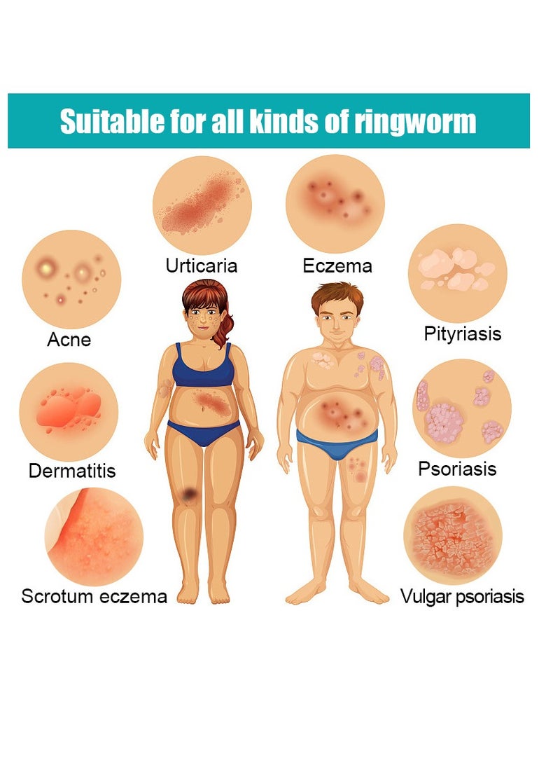 كاني إتش بي كريم الأكزيما  ، مرهم علاجي ذو قوة قصوى للطفح الجلدي ، الصدفية ، التهاب الجلد ، الشرى ، سعفة القدم ، حكة اللعب ، العدوى الفطرية ، مضاد للحكة ، يخفف من حساسية البشرة ، المتهيجة - Image 2