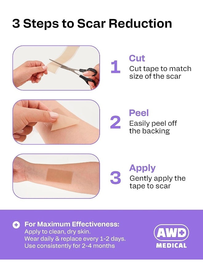 AWD Medical - AWD Medical Soft Silicone Tape for Scars Removal with Silicone Gel Sheeting (1.6inx 120in) - Image 1