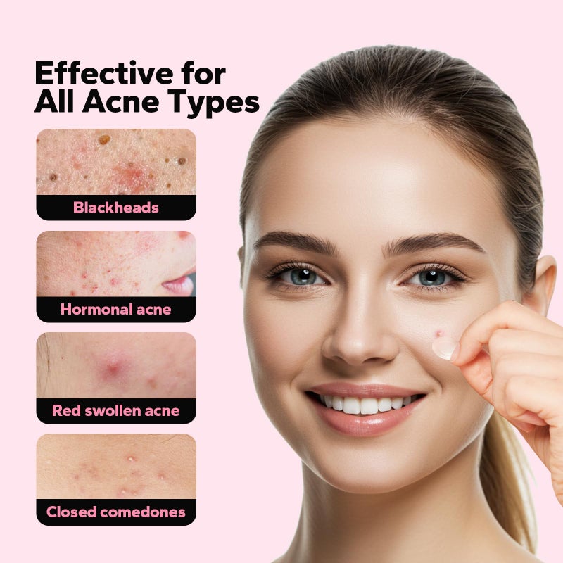 CharmCherry Pimple Patches for Face (18 Count), Microdart Acne Patches, Hydrocolloid Blemish Spot with Salicylic Acid, Fast-Acting for Early Stage Deep Pimples, Zits, Breakouts & Cystic Acne - Image 3