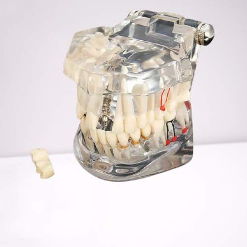 iDENTical All In One Dental Implant Model M2001 White Demonstration Model for Implant Training Prosthodontic Education Surgical Planning and Patient Explanation - Image 3