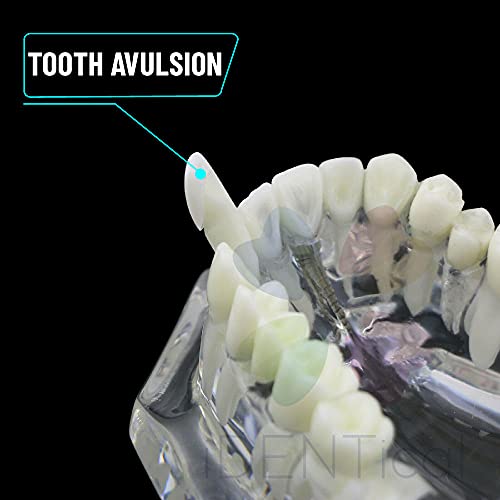 iDENTical All In One Dental Implant Model M2001 White Demonstration Model for Implant Training Prosthodontic Education Surgical Planning and Patient Explanation - Image 5