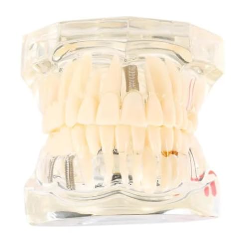 iDENTical All In One Dental Implant Model M2001 White Demonstration Model for Implant Training Prosthodontic Education Surgical Planning and Patient Explanation - Image 1