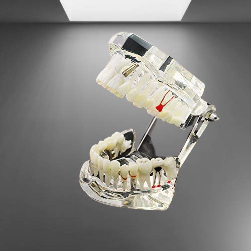iDENTical All In One Dental Implant Model M2001 White Demonstration Model for Implant Training Prosthodontic Education Surgical Planning and Patient Explanation - Image 2