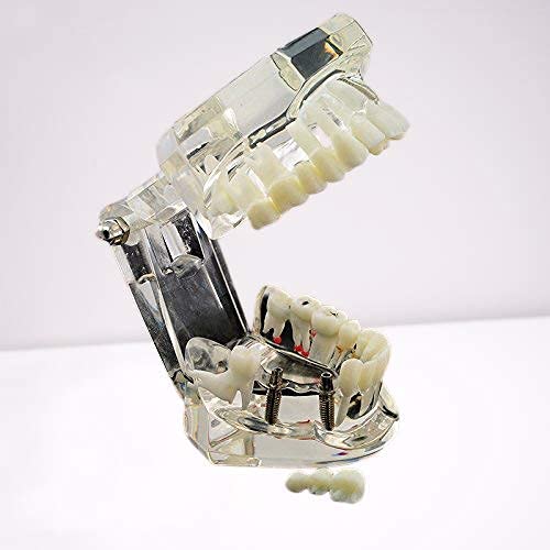 iDENTical All In One Dental Implant Model M2001 White Demonstration Model for Implant Training Prosthodontic Education Surgical Planning and Patient Explanation - Image 4