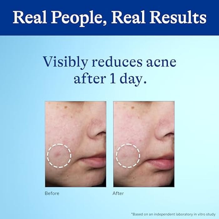 Differin Acne Spot Treatment with 10% Benzoyl Peroxide, Maximum Strength OTC Acne Treatment, Fast Acting Spot Treatment for Face, 1 oz - Image 5