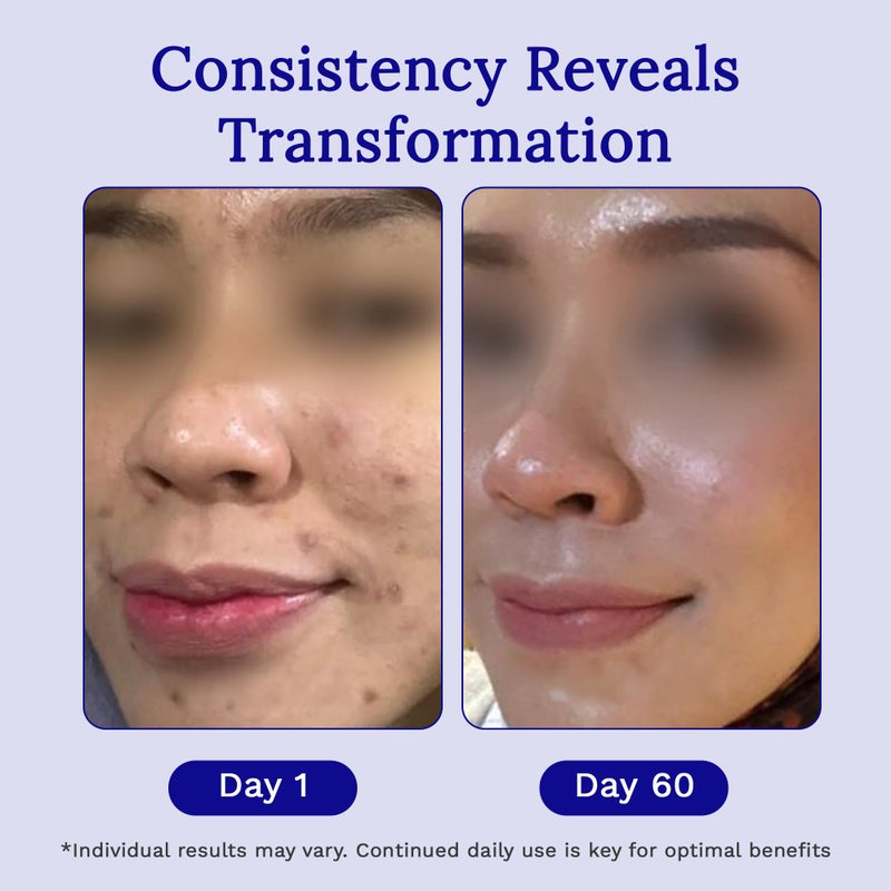 Rejuvaskin RejuvaSil Silicone Scar Gel, Scar Treatment for Surgical Scars, Burns, Keloids, Acne Scars on Face & Body, 30ml - Image 5