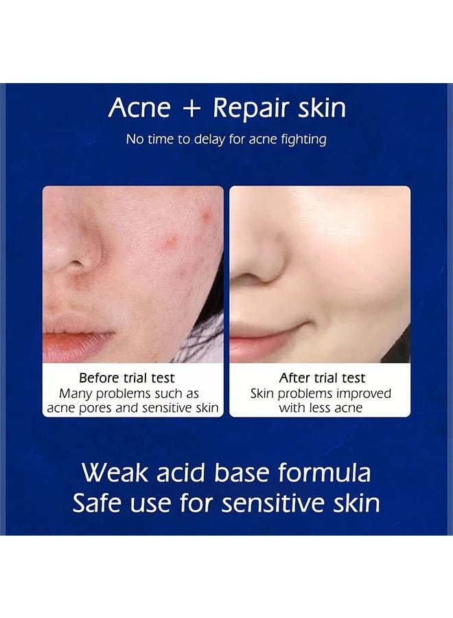 SENANA Gentle Acne Removal,Cystic, Hormonal, Severe Acne Cream for Teens & Adults with Hyaluronic Acid Aloe Vera Oil Cystic , Unisex Sensitive Skin Blind Pimple & Blemish (1 PACK) - Image 2