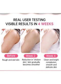 JoyPretty KP  Exfoliating Repair Cream, Exfoliate Treatment with Urea and Vitamin C, Moisturizing Hydrating Body Lotion for Dry, Rough and Bumpy Skin  - Image 4