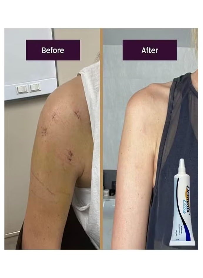 ديرماتيكس متقدمة ندبة هلام 15g لتحسين مستحضرات التجميل من الندوب ، والتجفيف السريع وصيغة هلام السيليكون فريدة من نوعها ، تستخدم لعلاج الكيلويد ، والندوب الجراحية والفرط ، مناسبة للبشرة الحساسة - Image 3