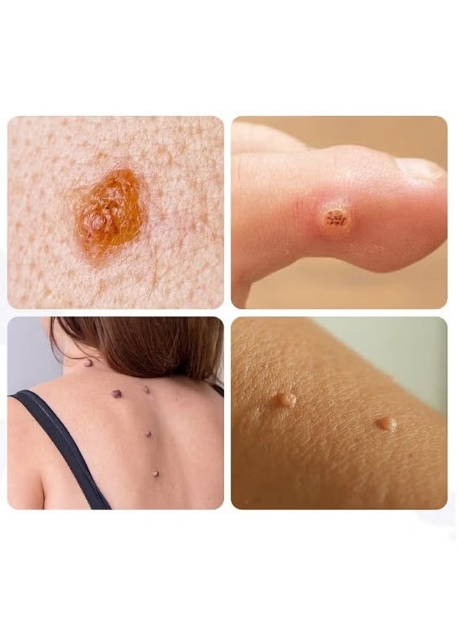 SAUVASINE Warts Remover 10ml, Gentle u0026 Effective Treatment for Common Warts, Plantar Warts, Flat Wart - Image 3