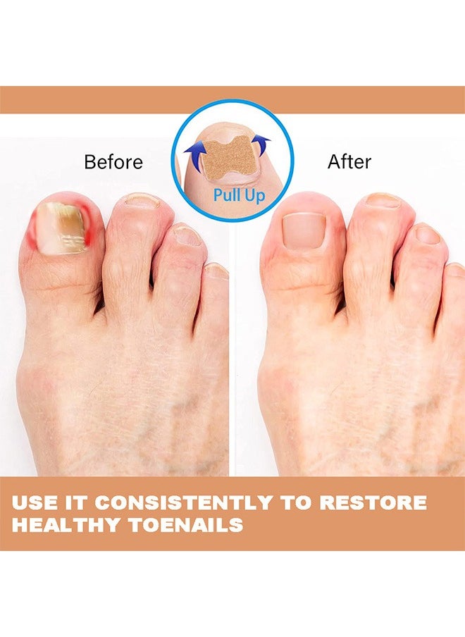 Flushy 120 Pcs Toenail Correction Patch, Ingrown Toenail Correction Sticker, Nail Treatment Corrector Sticker Pedicure Foot Care Tools (Color)  - Image 3