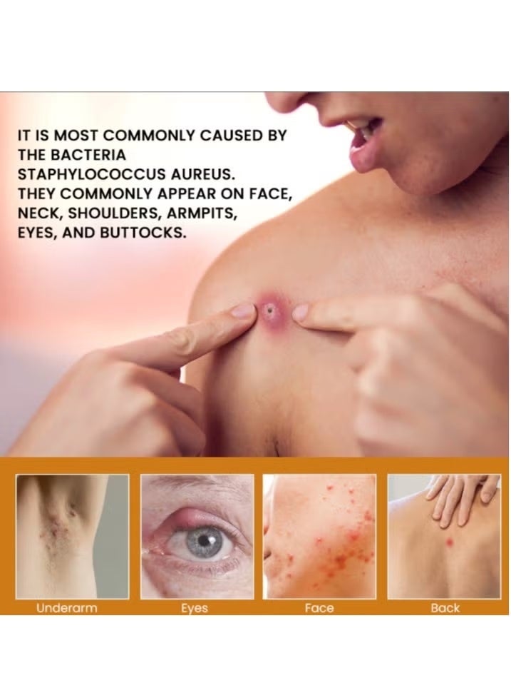 سوميفون كريم تخفيف الغليان يقلل الحرارة والتورم ويخفف التضخم والألم 20 جرام - Image 4