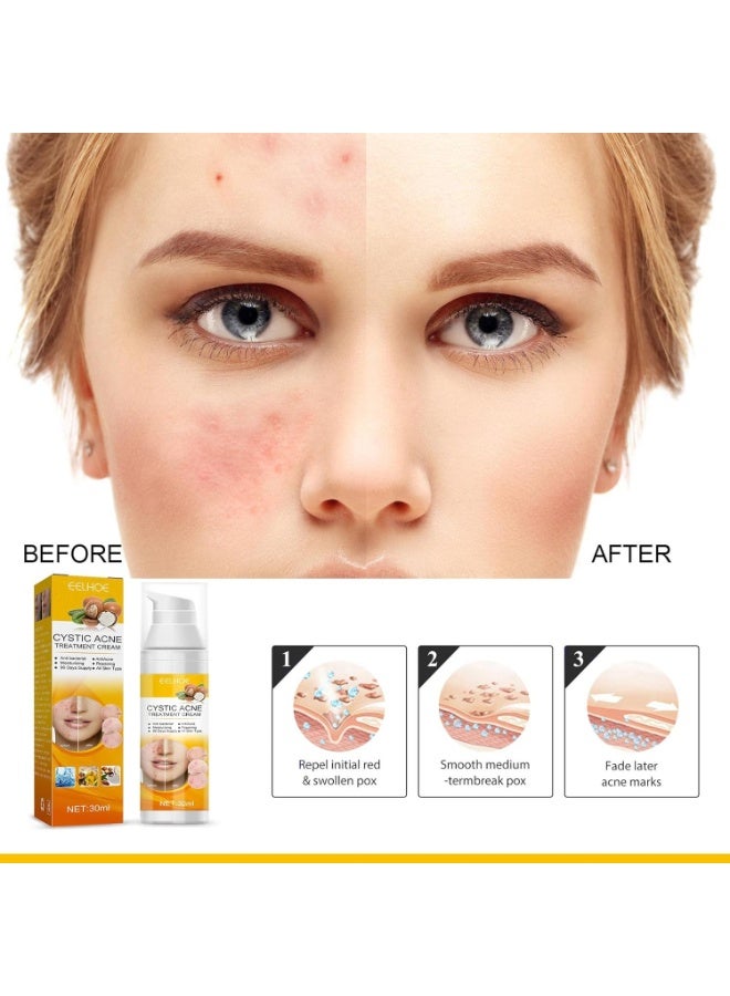 EELHOE Professional Cystic Acne Cream – Deep Repair, Redness Removal, Oil Balance & Smooth Skin Moisturizer for Everyday Results - Image 5