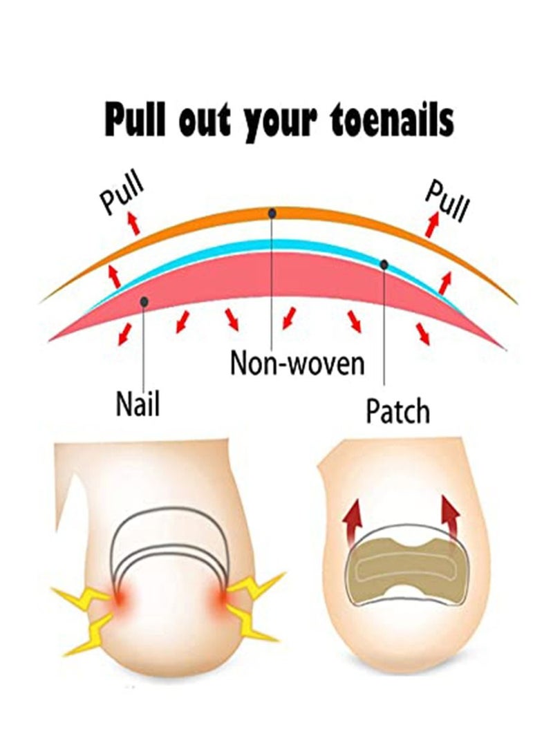 EELHOE 50 Pieces Toenail Correction Stickers Ingrown Toenail Corrector Strips Elastic Curved Toenails Brace Stickers - Image 5