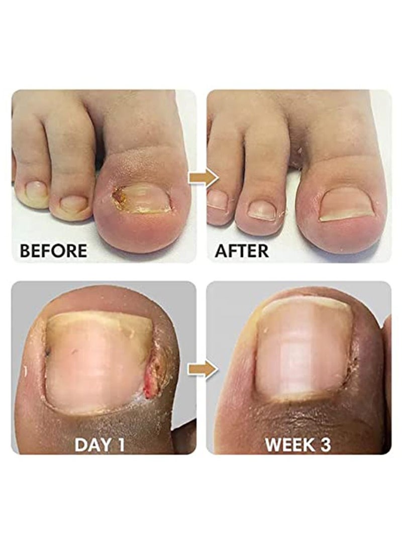 EELHOE 50 Pieces Toenail Correction Stickers Ingrown Toenail Corrector Strips Elastic Curved Toenails Brace Stickers - Image 4