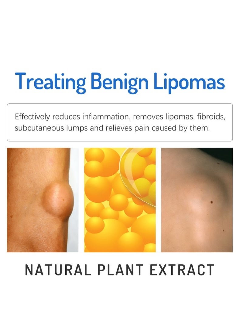 SOUTH MOON - Lipoma Removal Cream 20g, Lipoma Removal Cream Ointment, Lipoma Elimination Cream, Get Rid of Your Fatty Lipoma Lumps - Image 1