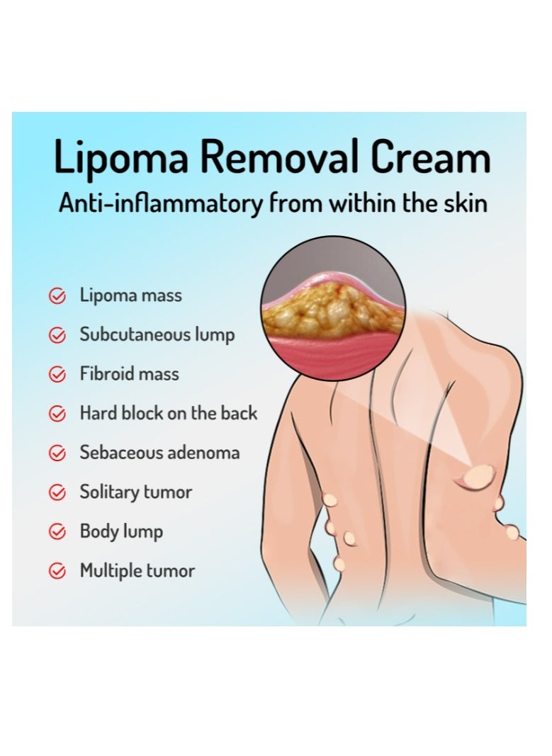 SOUTH MOON - Lipoma Removal Cream 20g, Lipoma Removal Cream Ointment, Lipoma Elimination Cream, Get Rid of Your Fatty Lipoma Lumps - Image 1