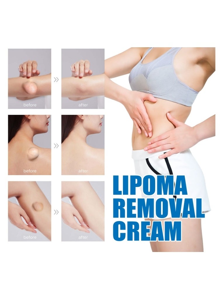 SOUTH MOON - Lipoma Removal Cream 20g, Lipoma Removal Cream Ointment, Lipoma Elimination Cream, Get Rid of Your Fatty Lipoma Lumps - Image 1