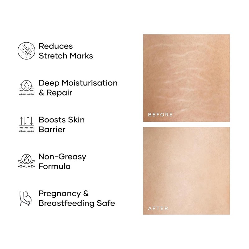 Cureskin Smoothing Body Butter Stretch Marks Cream for Women and Men Stretch Marks Removal Cream for Women - Image 3