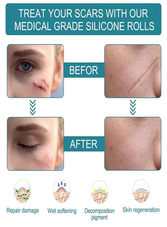 QUEBERS Silicone Scar Sheets | Medical-Grade Scar Removal Tape for Surgical Scars, C-Section, Tummy Tuck, Acne & Keloids | Reusable Silicone Scar Strips Safe & Effective Scar Treatment - Image 4