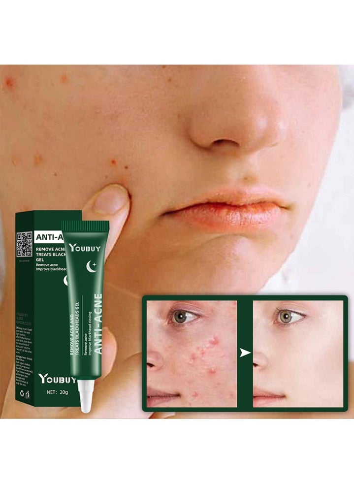 Youbuy مضاد لحب الشباب يزيل حب الشباب ويعالج الرؤوس السوداء جل الاستخدام الليلي يزيل حب الشباب والبثور ويعالج الرؤوس السوداء بحمض الساليسيليك يتحكم في زيت تقليص المسام تخفيف احمرار البشرة تفتيح الندبات كريم تتلاشى حب الشباب كريم مزيل حب الشباب 20 جم - Image 4