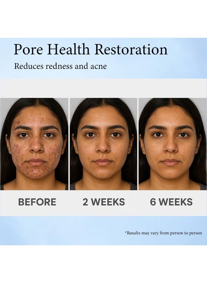 ATRJSZ 14% Azelaic Acid Acne Cream for Face,Advanced Azelaic Acid Serum,Redness Relief for Face, Redness Reducing Skin Care,Blackheads,Blemishes，Uneven Tone,30g - Image 5