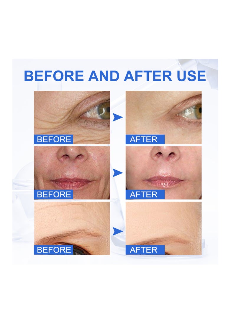 Botox Stock Solution for Lightens Fine Lines,Improves Nasolabial Folds,Anti-wrinkles