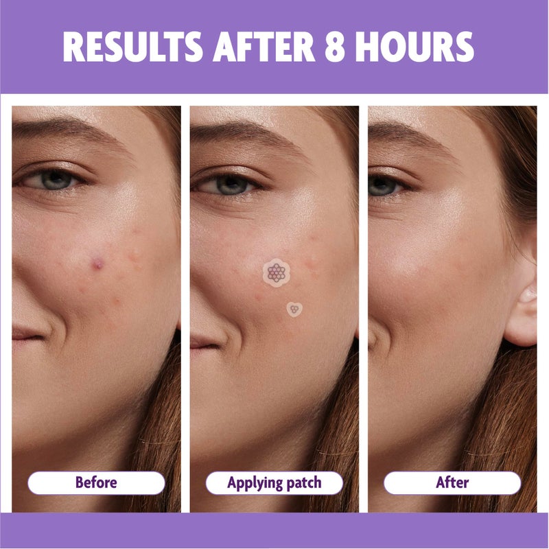 FreeGo Magnesium Acne Patch: Innovative Treatment for Acne, Dark Spots, Blemishes, and Cystic Acne - Patented & Clinically Tested Spot Solution (MEDIUM 8 PCS) - Image 5
