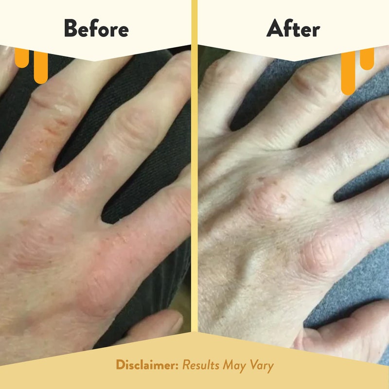 ECZEMA HONEY Oatmeal Hand Cream - Natural Hand & Body Lotion for Eczema Rash Relief - Eczema Cream for Dry, Itchy, Sensitive, & Irritable Skin (2 Oz) - Image 4